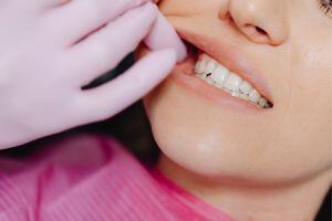 Realiza este remedio casero con aceite de romero para eliminar el sarro dental