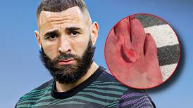 VIDEO | Karim Benzemá hace un gol, juega 80 minutos con un corte de cinco centímetros en el pie y recibe sutura