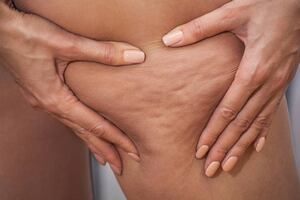 ¿Tienes celulitis y no sabes por qué? Te decimos las causas