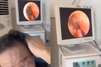 VIDEO | Fue al otorrino por un dolor de oído y descubrieron que una araña hizo un nido adentro