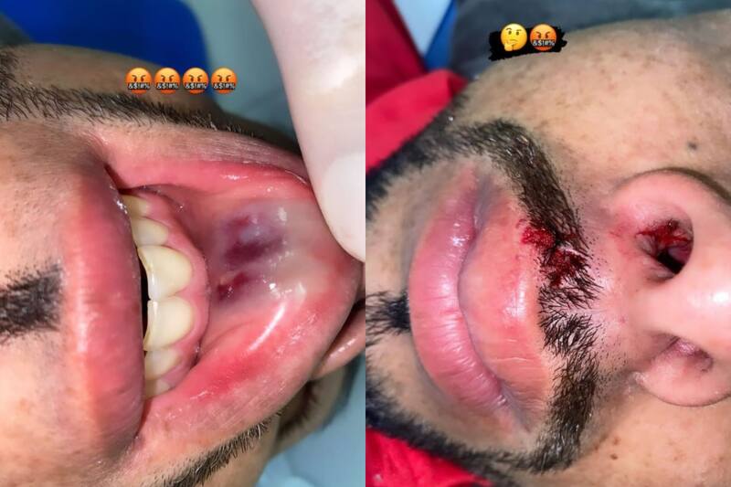 muestra cómo quedó su rostro tras la dura entrada de Matías Sepúlveda.