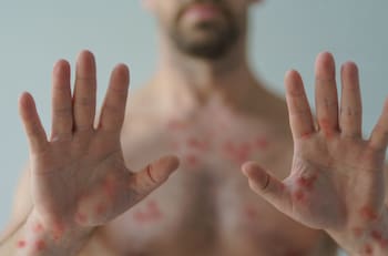 Confirman primer caso de la variante más peligrosa de la Viruela del Mono fuera de África