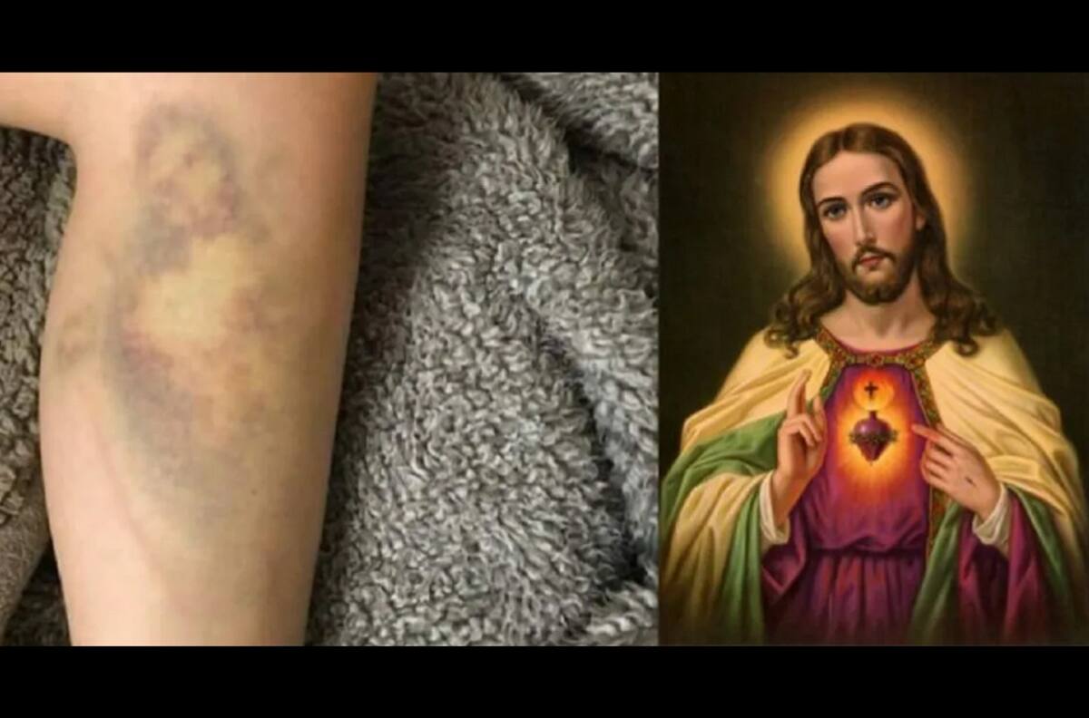 ¿Milagro de Semana Santa?: Sufrió golpe y le salió moretón con la cara de Jesús