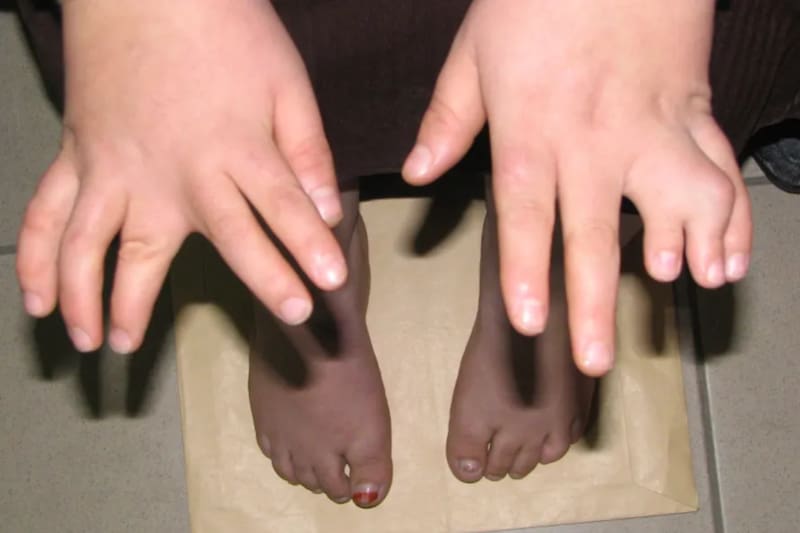 Este puede afectar la visión, el peso y el desarrollo físico.