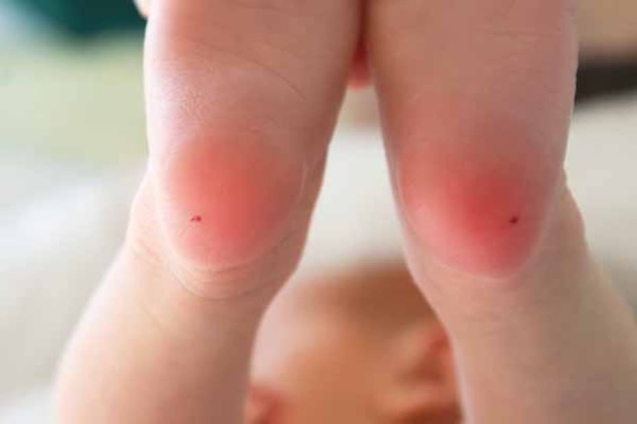 Un diagnóstico temprano de fenilcetonuria permite llevar una vida normal con dieta estricta.
