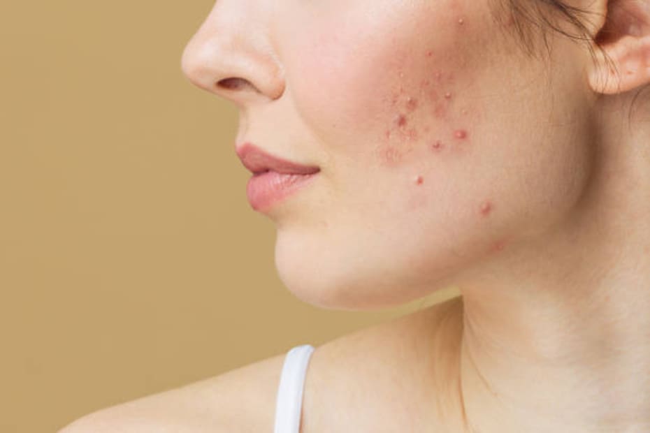 Es común confundir el acné con demodex
