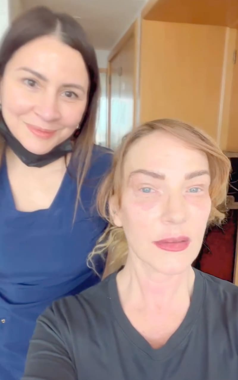 Cata Pulido y su intervención estética.