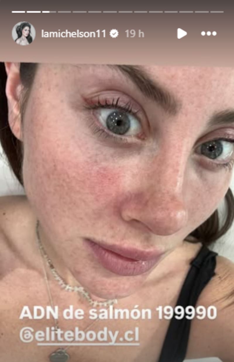 La influencer comentó que antes tenía un sobre relleno de filler.