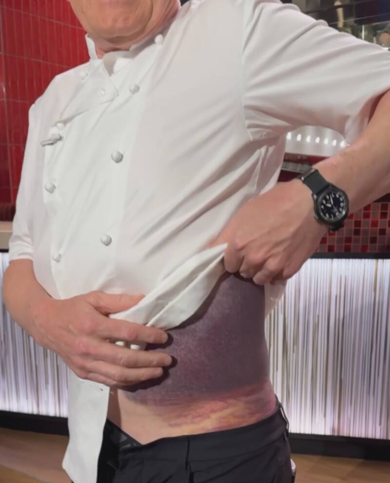 Así quedó el torso de Gordon Ramsay tras el accidente que casi cobró su vida