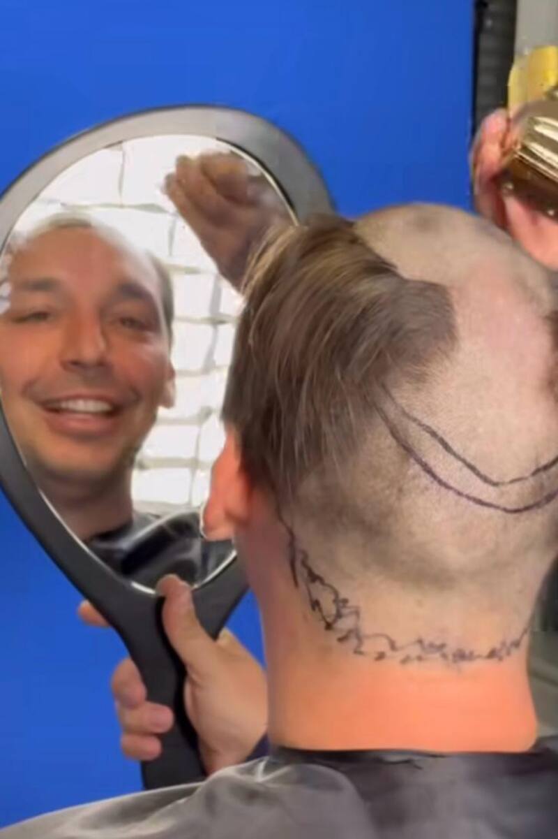 Rodrigo Gallina se rapó para injertarse nuevos pelos.