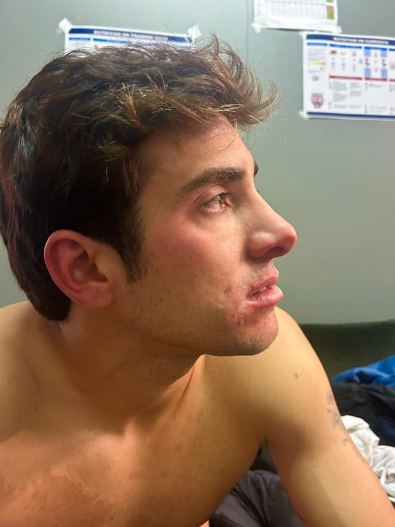 Así quedó su rostro tras la agresión sufrida en Copa Davis.