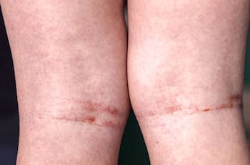 ¿Qué es la fiebre escarlatina? La enfermedad que preocupa en Talca tras confirmación de 5 casos