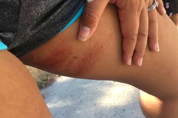 3 tips para combatir las irritaciones en la entrepierna por rozadura durante la temporada de calor