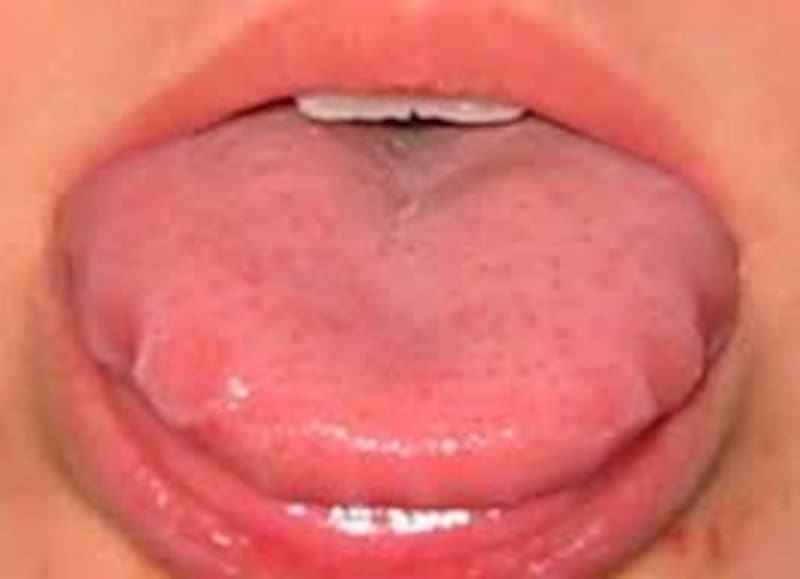 No siempre tener una lengua roja es indicativo de buena salud.