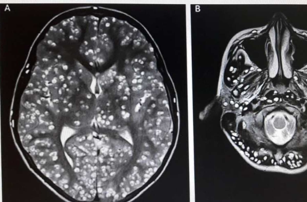 Hombre vivió con su cerebro lleno de gusanos por más de 20 años: lo notó cuando tuvo convulsiones