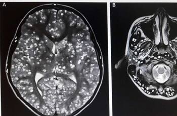 Hombre vivió con su cerebro lleno de gusanos por más de 20 años: lo notó cuando tuvo convulsiones