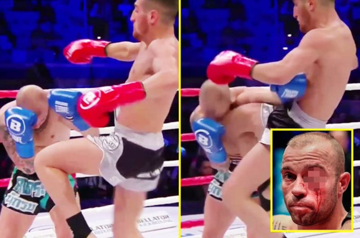 Impactante: Así quedó el rostro de Alex Avogadro tras recibir un rodillazo volador