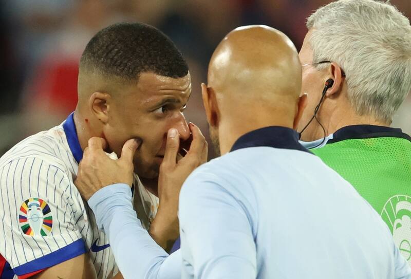 Kylian Mbappé sufrió una fractura nasal y es duda para el partido entre Francia y Países Bajos.