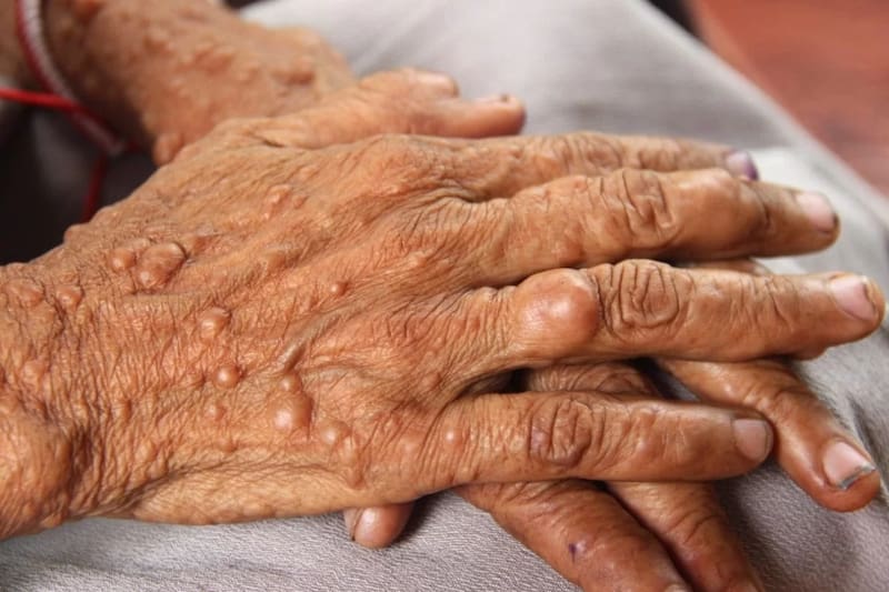 Formación de tumores en los nervios y alteraciones cutáneas visibles.