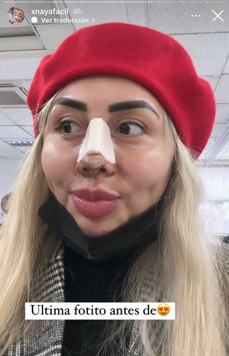 Naya fácil reveló los resultados de su cirugía. Foto: Instagram.