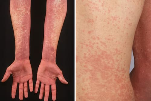 Es provocada por un grupo de bacterias que son contagiosas.