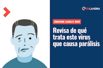 ¿Qué es el síndrome de Ramsay Hunt? Conoce los síntomas del virus que puede causar parálisis facial