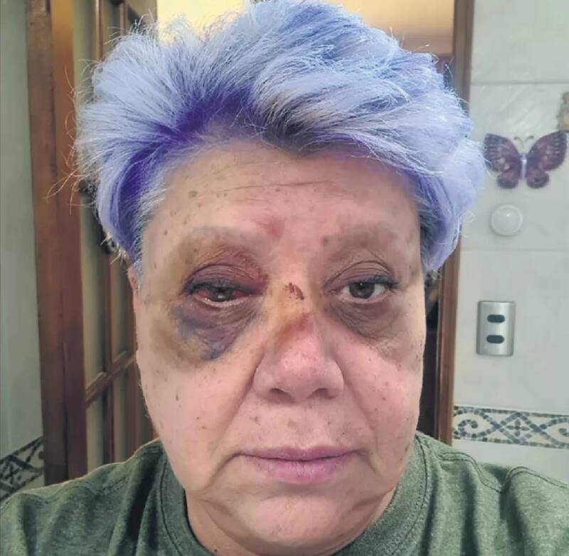 Paty Maldonado muestra su cara por primera vez tras su accidente de tránsito.