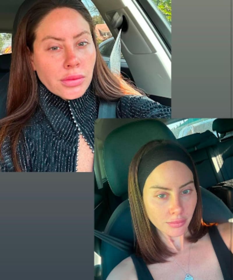 La influencer compartió él antes y después de su cara, tras el tratamiento con ADN de salmón.