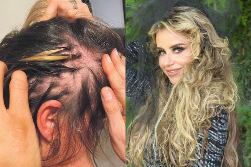 habló de su condición: La Alopecia.