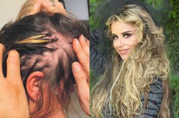 ¿Qué es la Alopecia? El trastorno que afecta a Amanda Cibely, ex chica “Mekano”