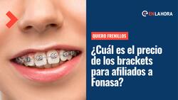 "Quiero Frenillos": ¿Cuál es el precio de los brackets para niños y adultos afiliados a Fonasa?