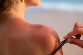 Remedios naturales para tratar las quemaduras de sol