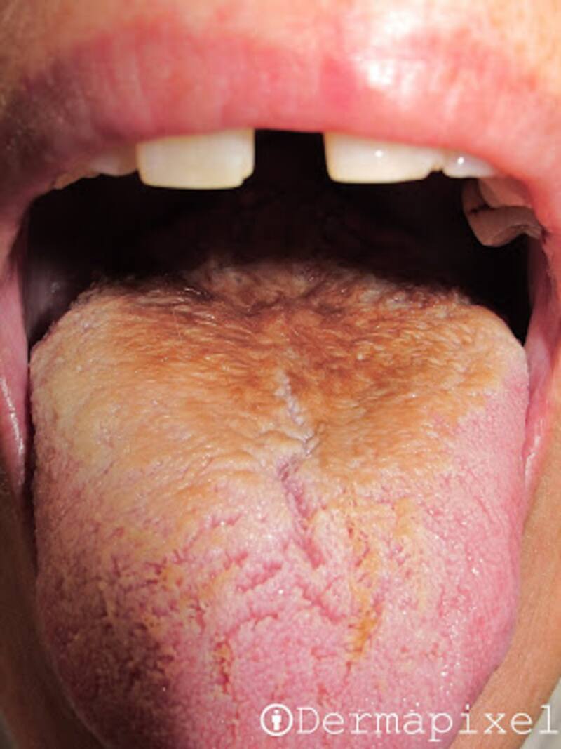 Se presenta más en personas fumadoras.