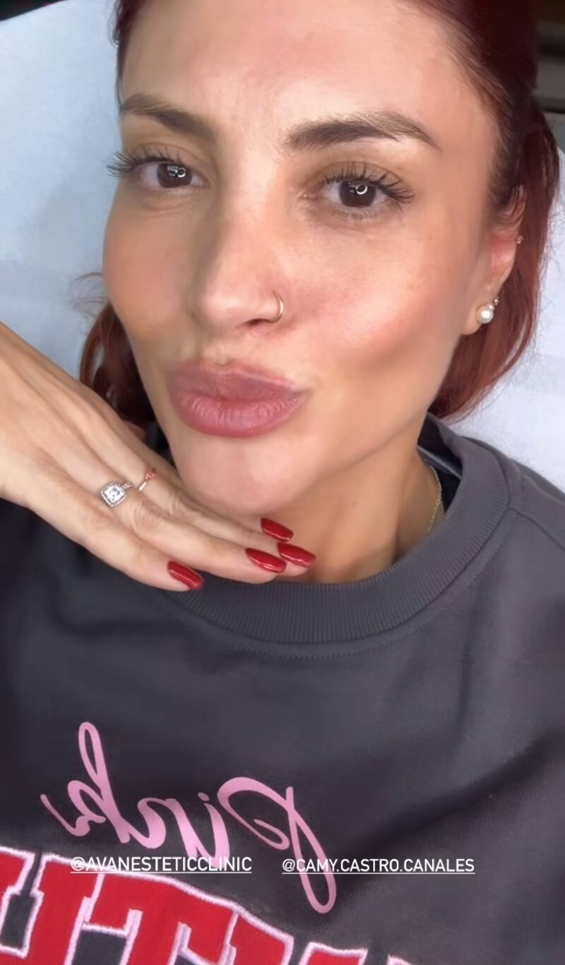 Karen Paola se inyectó ácido hialurónico. Créditos: Instagram