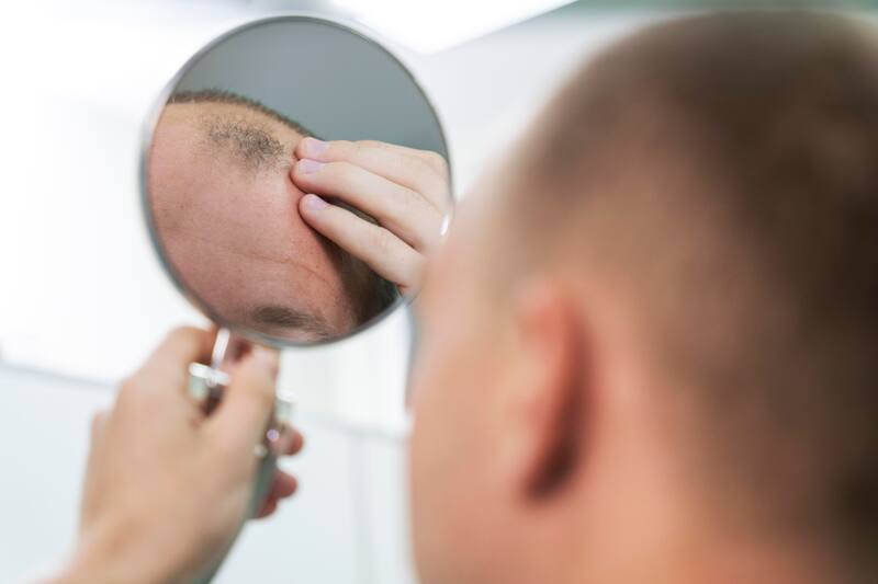 En su mayoría, la Finasterida se utiliza para el tratamiento de la alopecia androgénica en hombres.