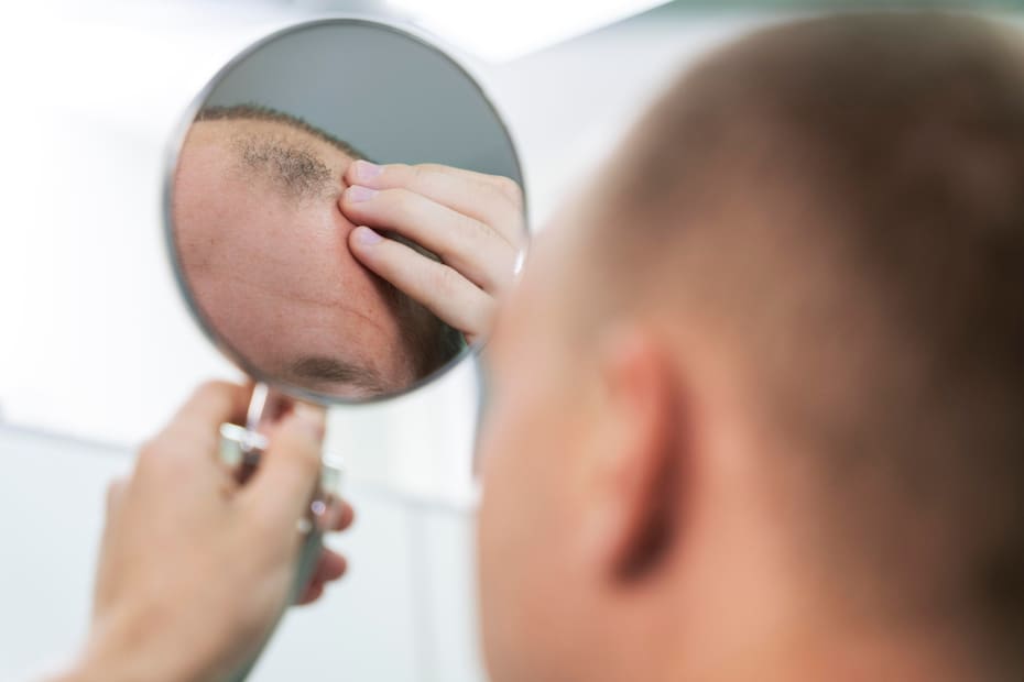 En su mayoría, la Finasterida se utiliza para el tratamiento de la alopecia androgénica en hombres.
