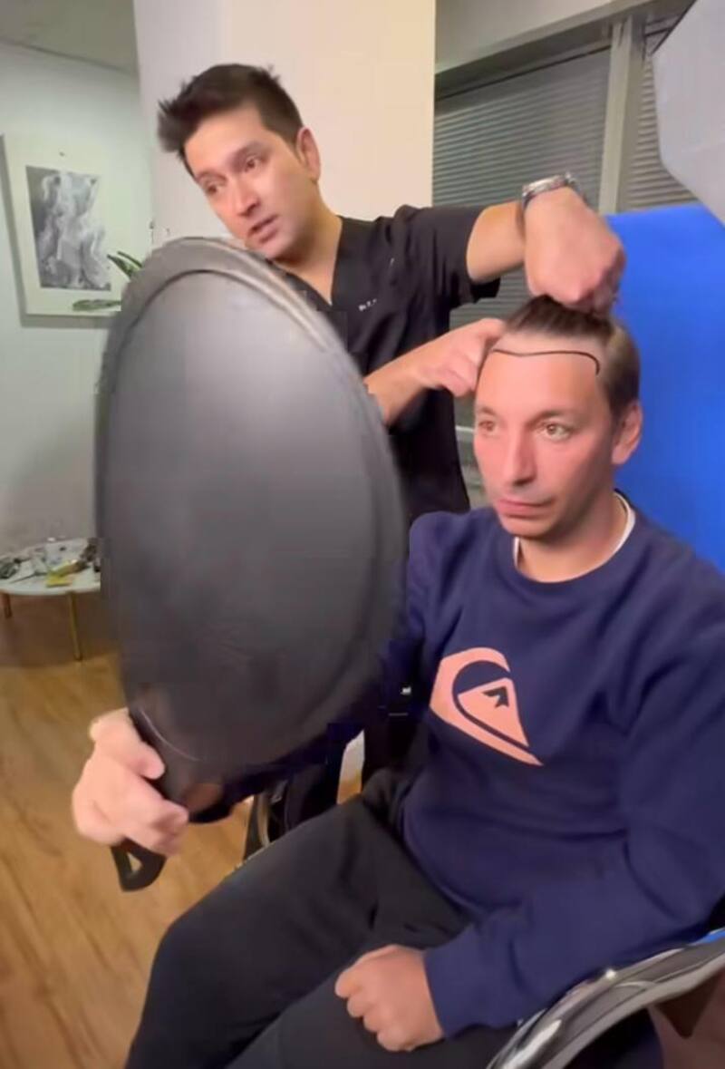 Rodrigo Gallina se sometió a una cirugía de injerto capilar.