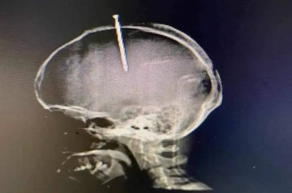 Increíble: Hombre se enterró un clavo en la cabeza porque sentía su cerebro flojo