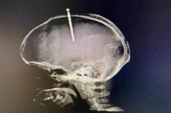 Increíble: Hombre se enterró un clavo en la cabeza porque sentía su cerebro flojo