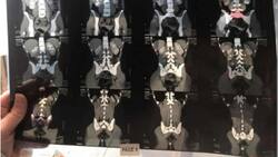 Tiene dos vaginas: Mujer creyó hasta los 16 años que era normal