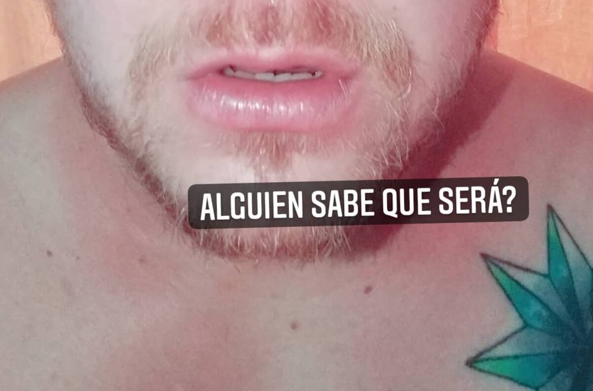 La extraña inflamación que afectó a Ariel Osses, recordado “Elfi” de “Yingo”: “Mi nariz era como una pelota de tenis”