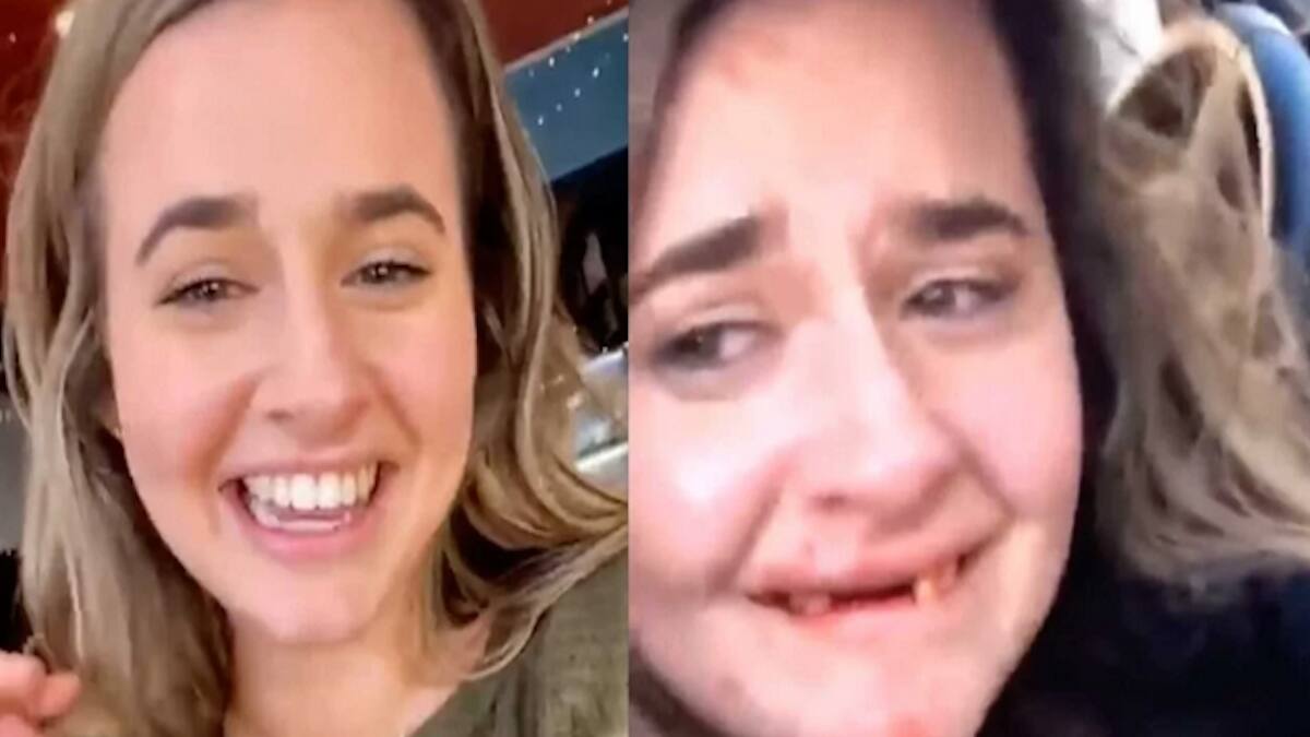 Reto en Tiktok terminó mal: joven perdió sus dientes y tuvo que ser operada