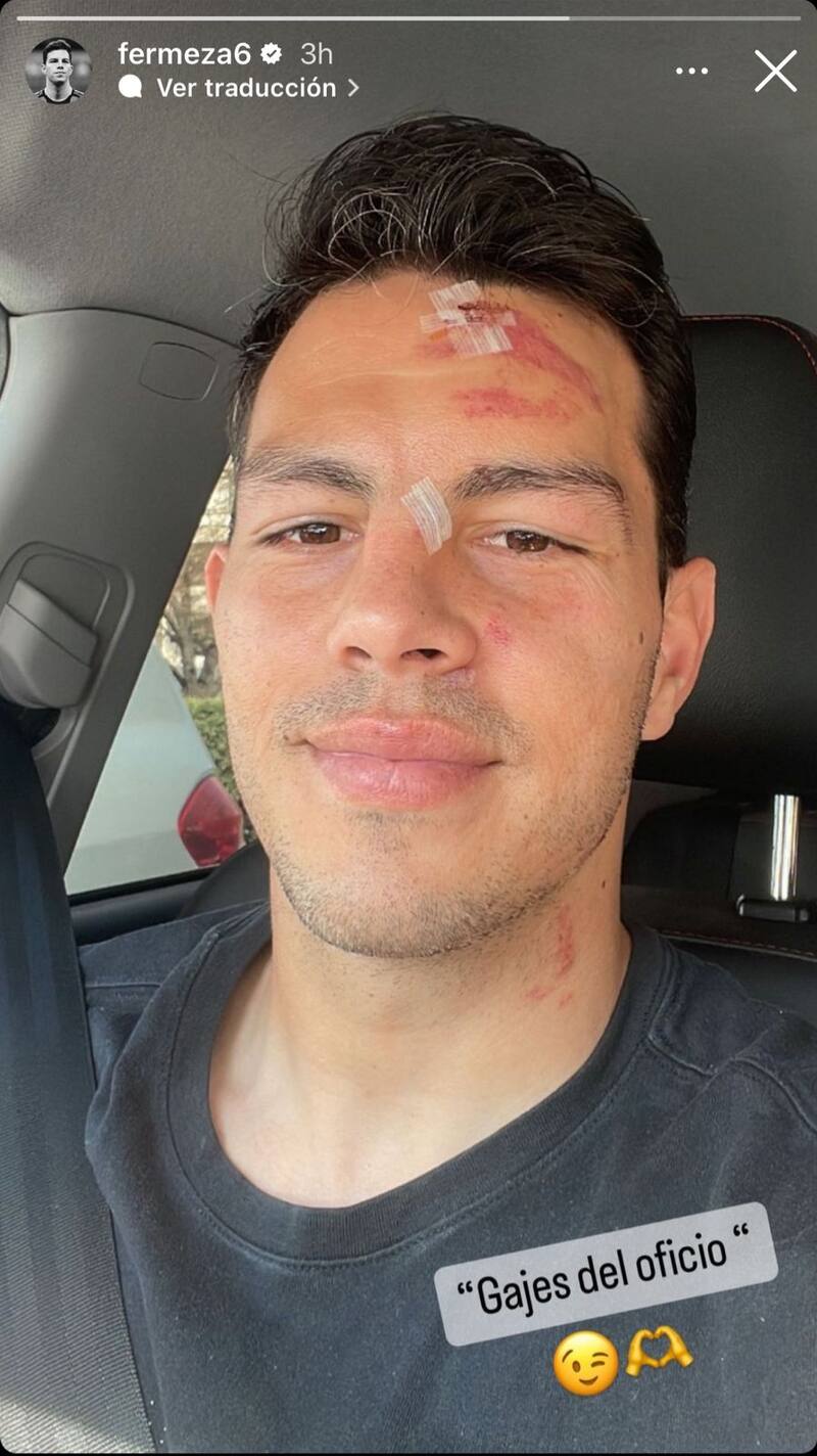 El defensa de Palestino mostró las heridas que le provocó la fuerte entrada de Jeyson Rojas en el partido ante Colo Colo por Copa Chile. (Foto: Captura)