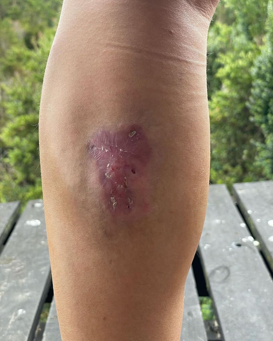 Sanó completamente su herida tras ser mordida por una araña de rincón.