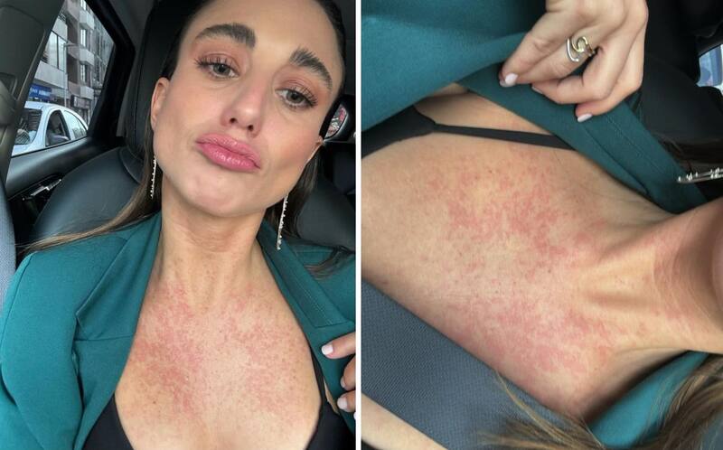 Tita Ureta mostró sus manchas en la piel. Créditos: Instagram