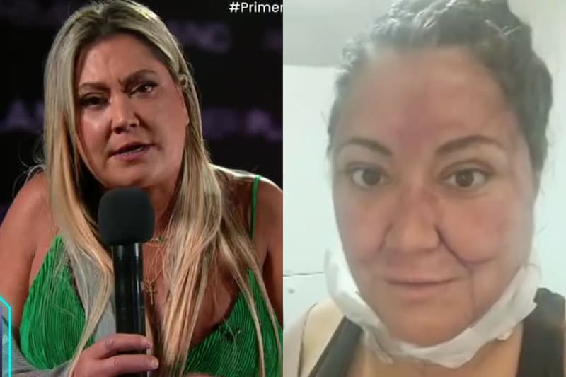 La gemela se sometió a impactante cirugía estética.