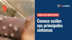 Viruela del mono: ¿Cuáles son sus principales síntomas, cómo se transmite y qué hacer para evitar el contagio?