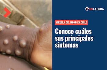 Viruela del mono: ¿Cuáles son sus principales síntomas, cómo se transmite y qué hacer para evitar el contagio?