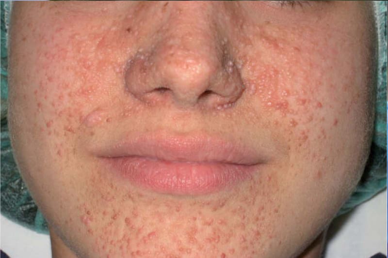 Desarrollo de tumores benignos en distintos órganos del cuerpo.