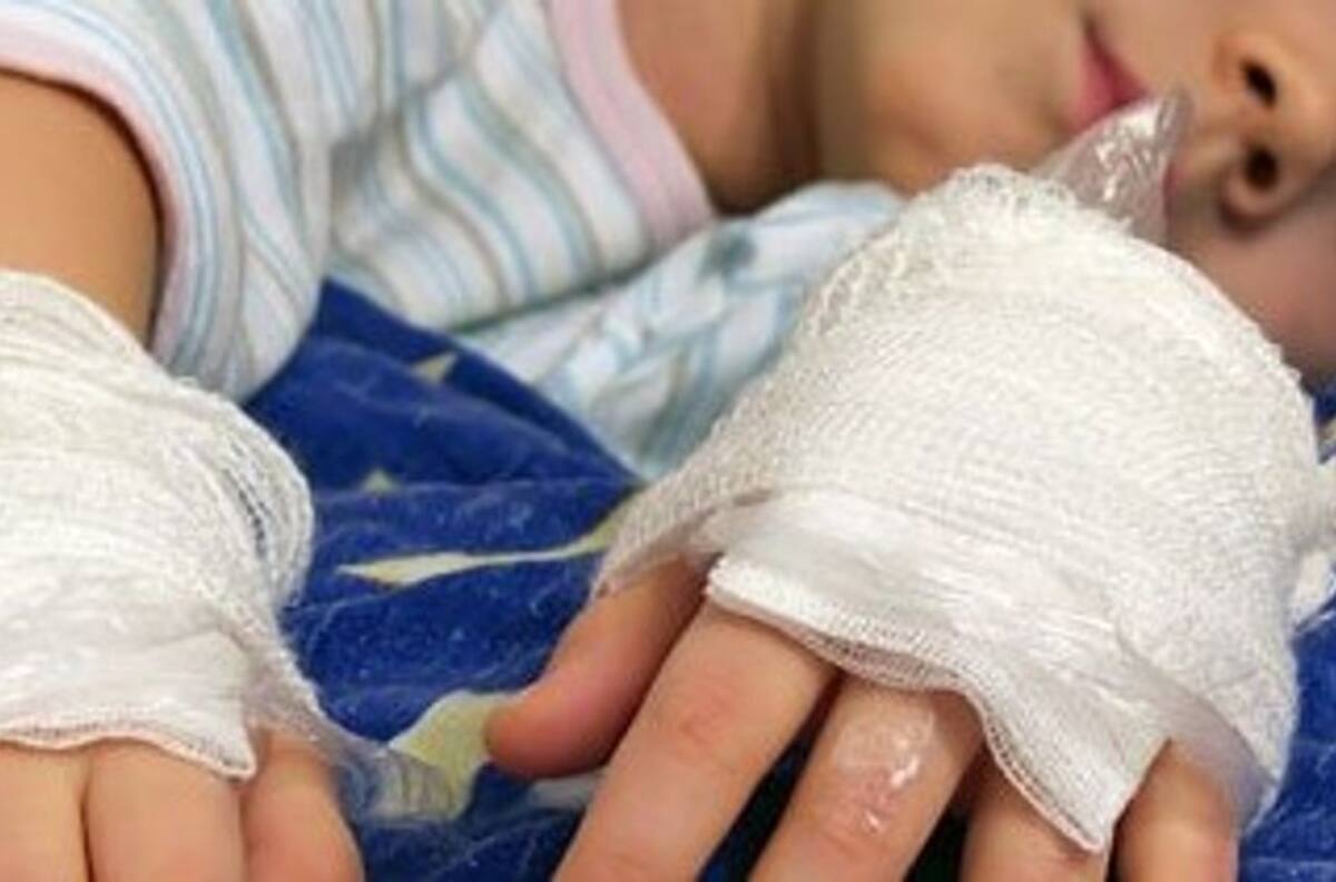Madre denuncia que a su hijo de 6 años un compañero de curso le roció alcohol gel en sus manos y luego se las quemó
